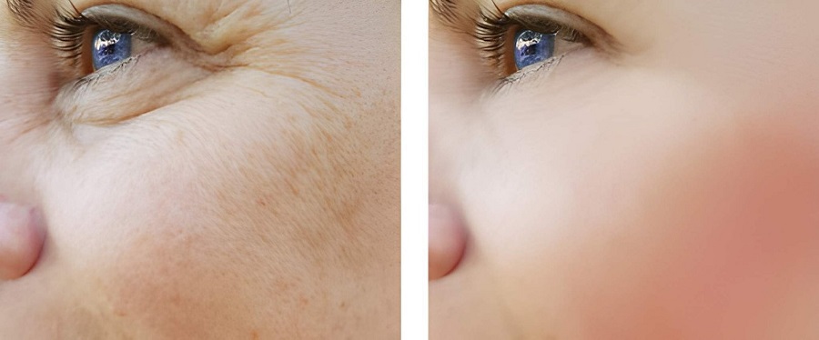 Best Pigmentation Treatment in Andheri